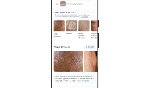 Google Google hilft Ihnen jetzt bei der Identifizierung von Hauterkrankungen