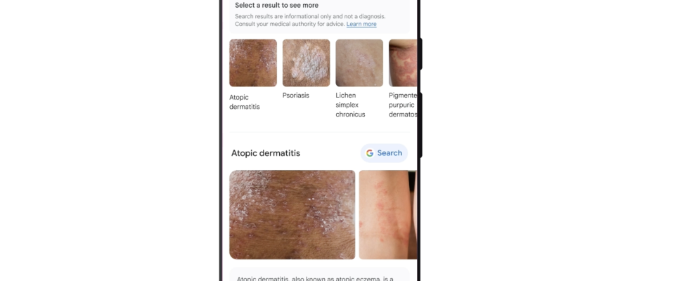 Google Google hilft Ihnen jetzt bei der Identifizierung von Hauterkrankungen