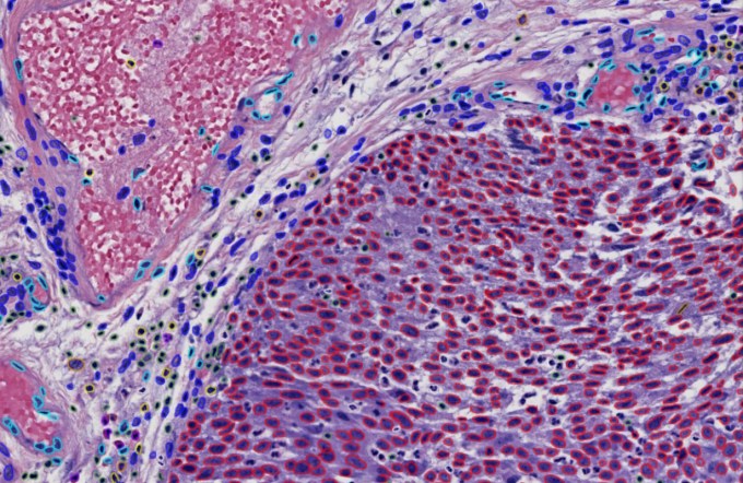 Valar Labs stellt KI gestuetztes Prognosetool fuer die Krebsbehandlung vor und