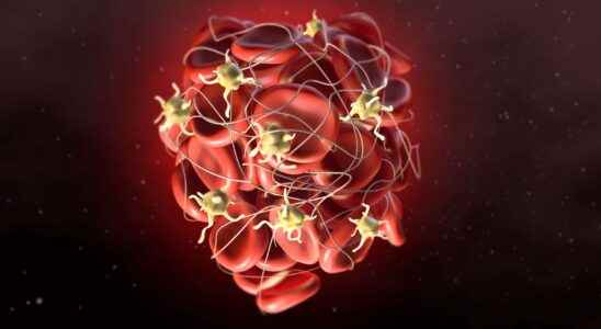 Blood vessel thrombosis what is it