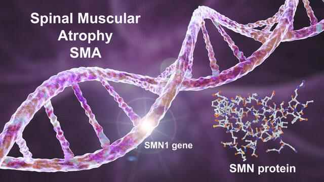 How is premarital SMA screening done Hospitals that screen for