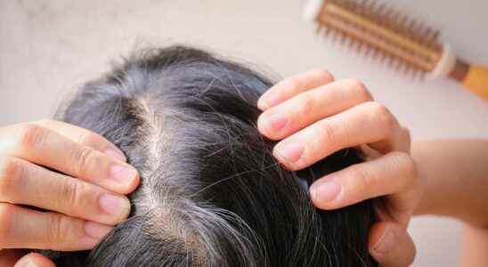 How to prevent hair loss