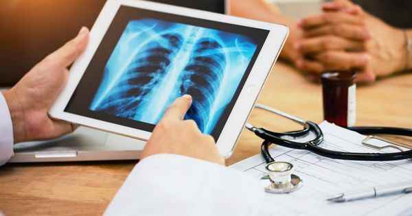 Lung cancer non smokers increasingly affected