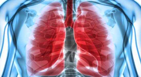 Pneumothorax what is it