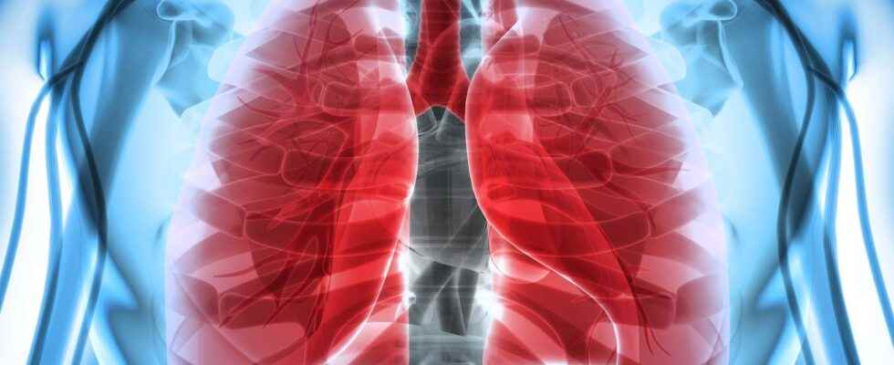 Pneumothorax what is it