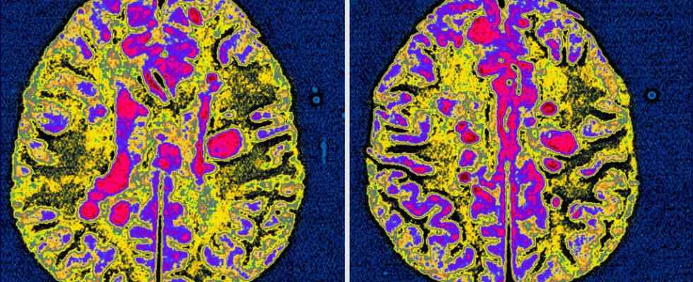 Researchers identify a virus as responsible for multiple sclerosis