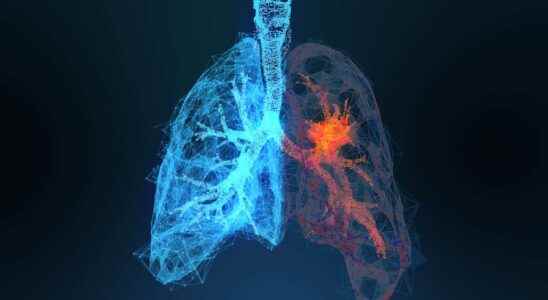 Why are lung cancers increasing in women and non smokers