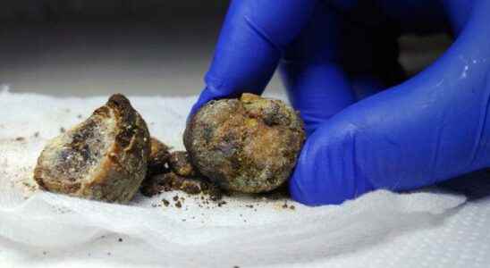 What is gallbladder stone how is it formed what are