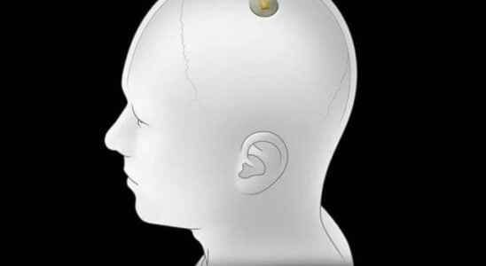 What was said about Elon Musks Neuralink brain chip project