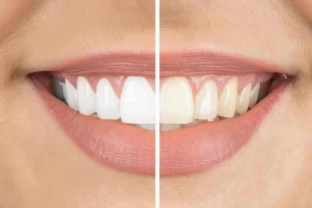 White teeth are not a dream!  Teeth whitening naturally