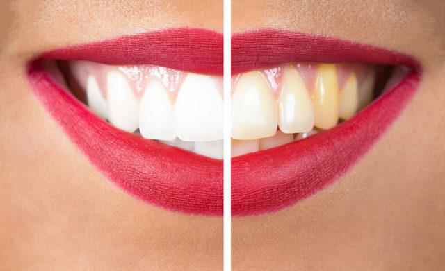 White teeth are not a dream!  Teeth whitening naturally