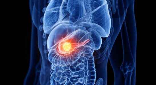 Pancreatic cancer towards early detection through stool analysis