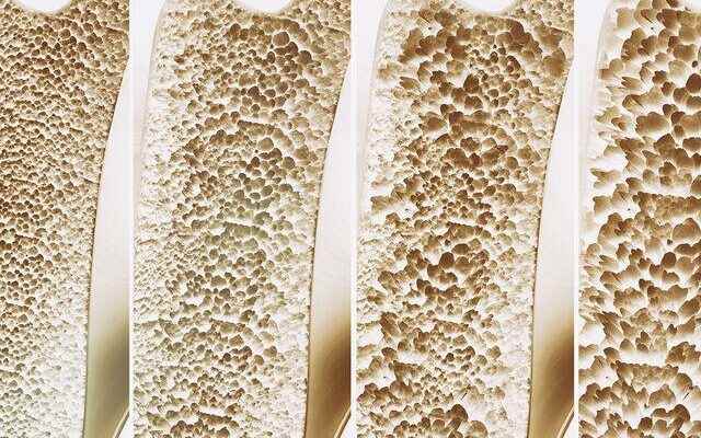 To slow the progression of bone resorption