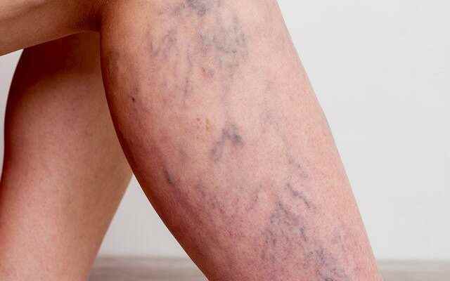 What are the causes and symptoms of varicose veins Here