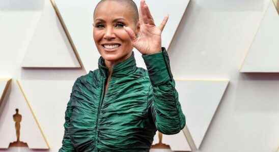 Alopecia what is this disease suffered by Jada Pinkett Smith