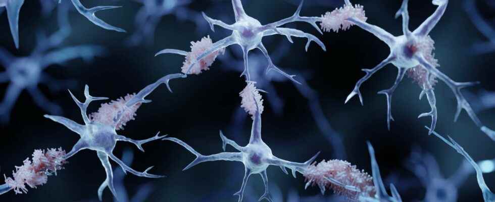 Alzheimers disease 75 genetic risk factors have been identified