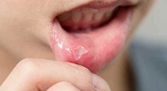 Behcets disease what is it