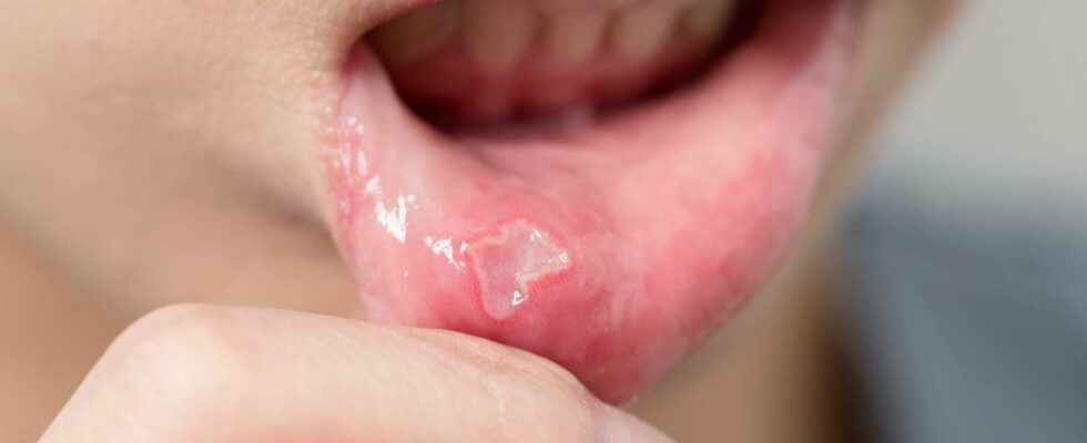 Behcets disease what is it