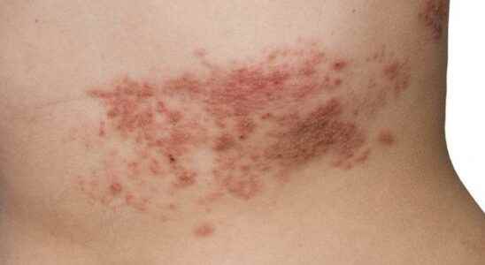 Consume plenty for the treatment of shingles