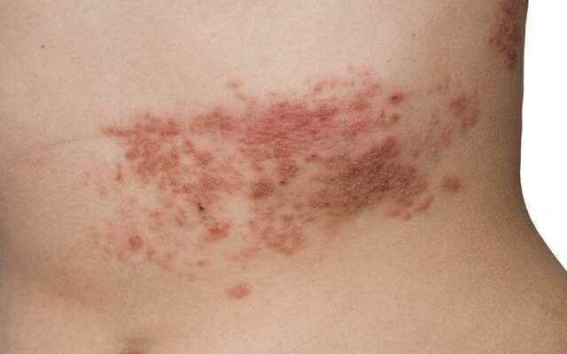 Consume plenty for the treatment of shingles