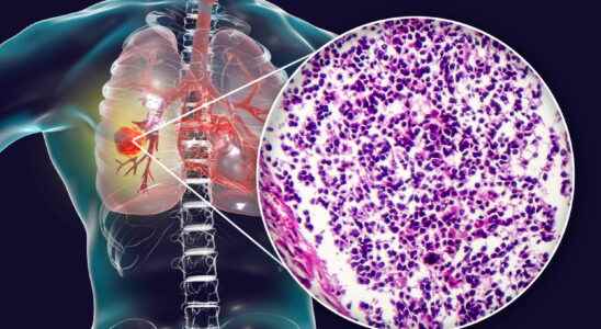 Immunochemo the new treatment for lung cancer