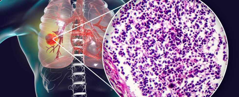 Immunochemo the new treatment for lung cancer