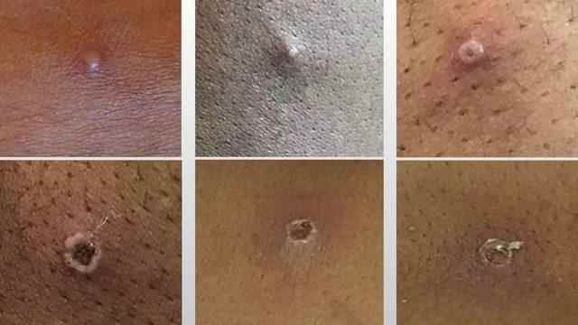 skynews-monkeypox-spots_5780435