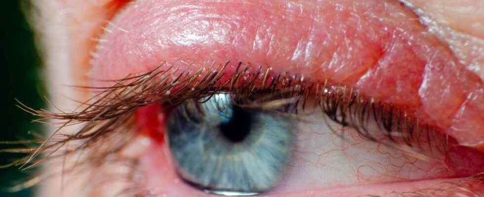 Blepharitis what is it