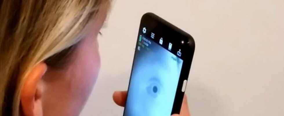 Eye selfies an application could soon detect Alzheimers disease and