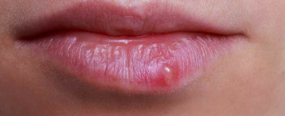 How to differentiate between a herpes labialis pimple and an