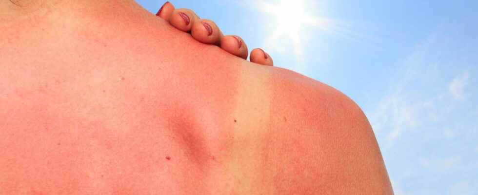 How to treat a sunburn