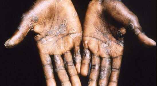 LAST MINUTE Fears are happening Monkeypox virus spread to