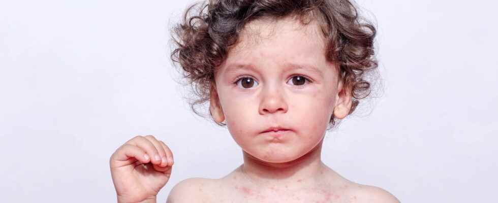 Measles epidemic alert what are the symptoms