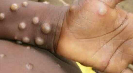 Monkeypox virus alarm in Europe After England it was also