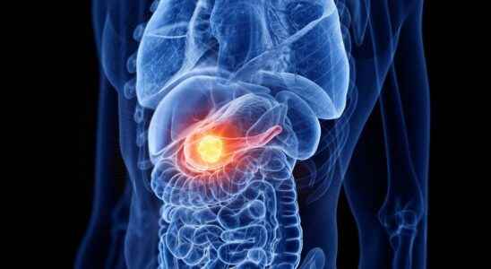 Pancreatic cancer a new vaccine would protect against the disease