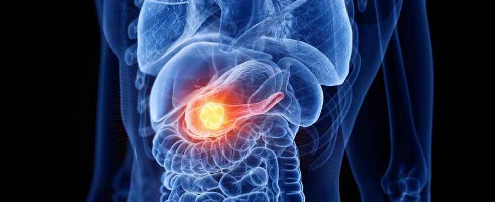 Pancreatic cancer a new vaccine would protect against the disease