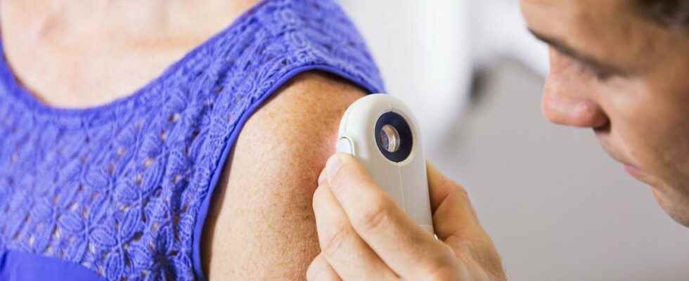 Skin cancer more than 7 million Europeans affected a majority