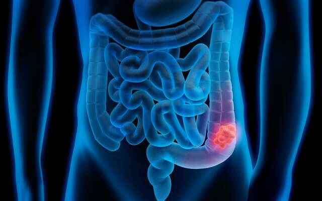 Think twice before you eat Causes colon cancer