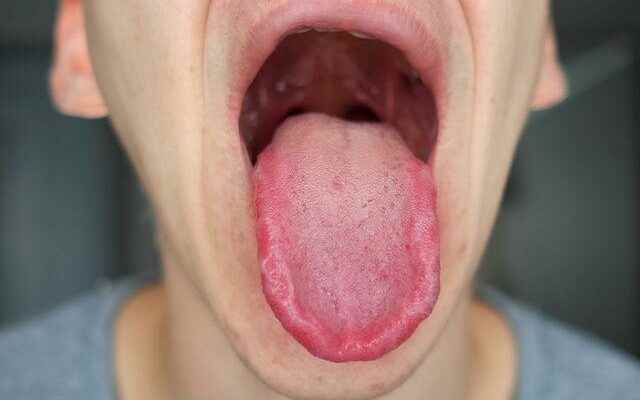 End your pain To treat tongue sores