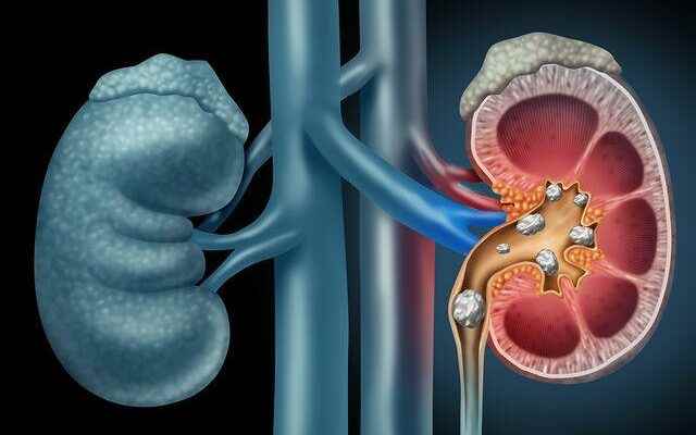 It causes kidney failure Pay attention to its symptoms