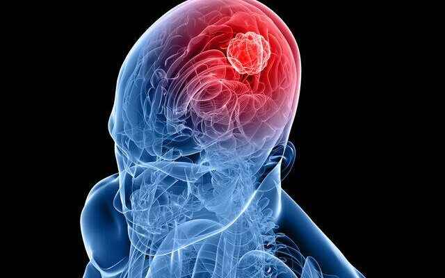 It started to be implemented in Turkey Pinpoints brain tumor