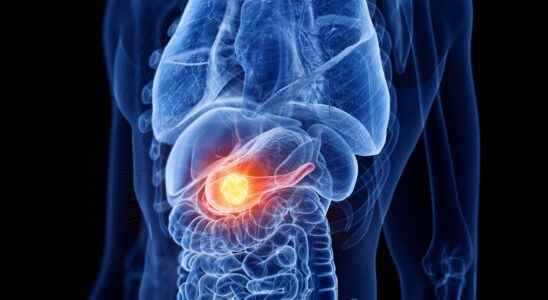 Pancreatic cancer an mRNA vaccine offers new hope