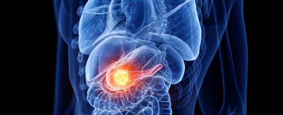 Pancreatic cancer an mRNA vaccine offers new hope