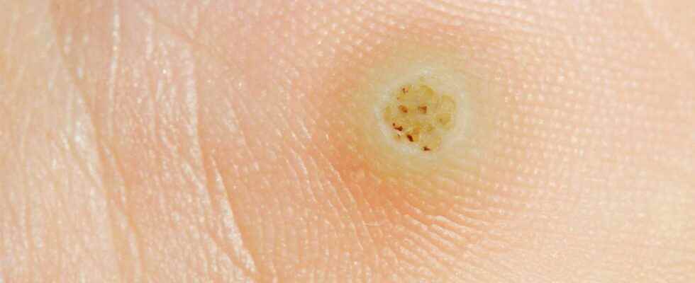 Plantar wart what is it