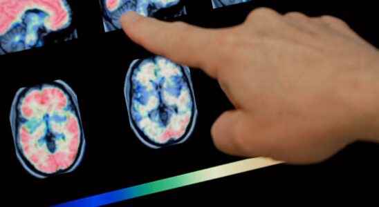 Researchers pinpoint cause of schizophrenia