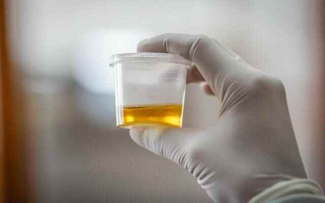 The color of your urine gives an important clue about