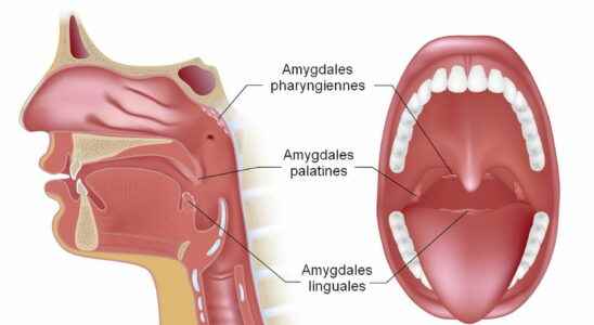 Tonsil surgery pain why what risks