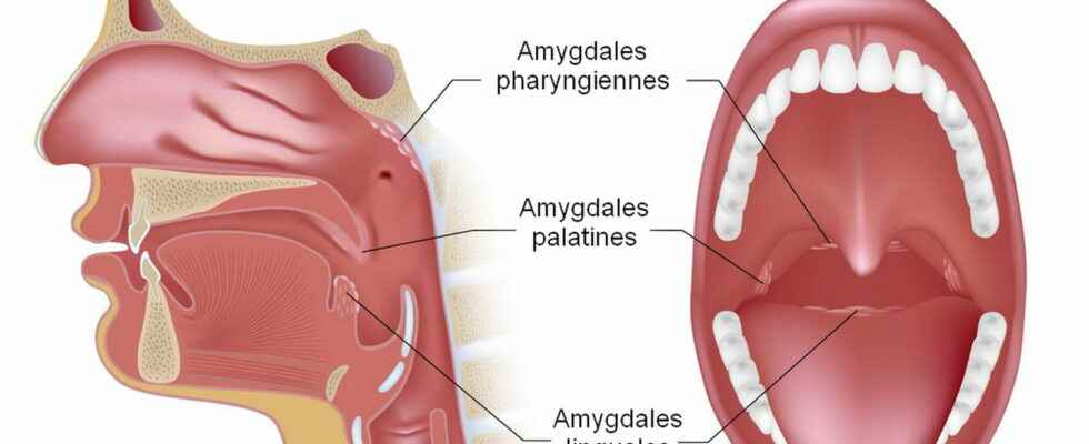 Tonsil surgery pain why what risks