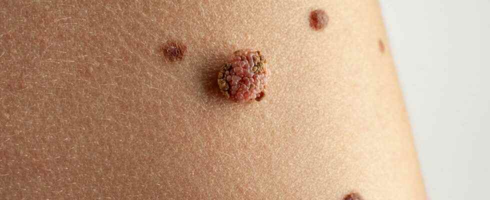 What is the difference between carcinoma and melanoma