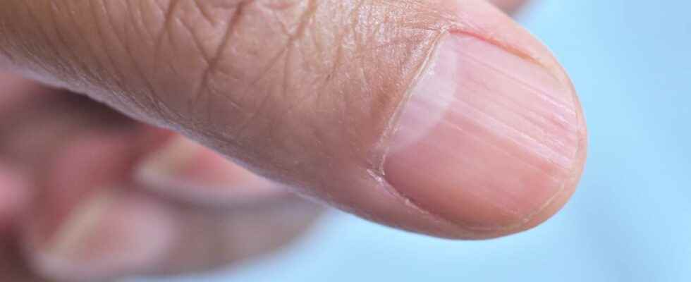 Bizarre patient a strange disease that causes fingernails and toenails